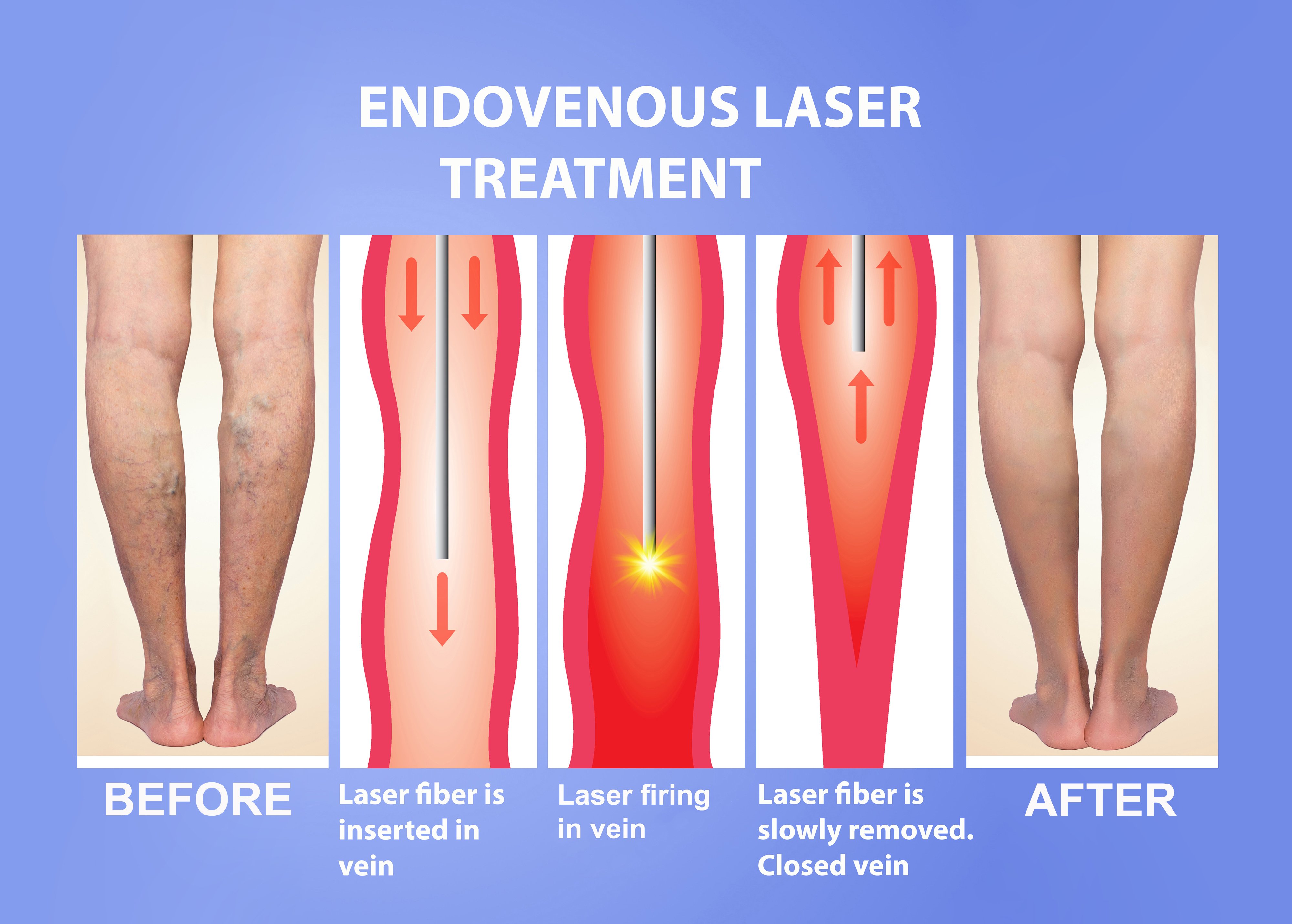 Dr. Ştefan Jianu despre tratamentul endovenos cu laser